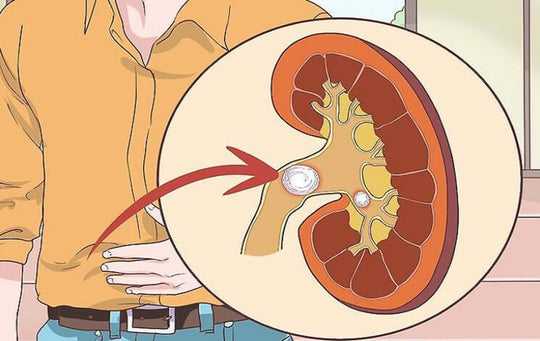 Ayurvedic Medicine for Kidney Stones