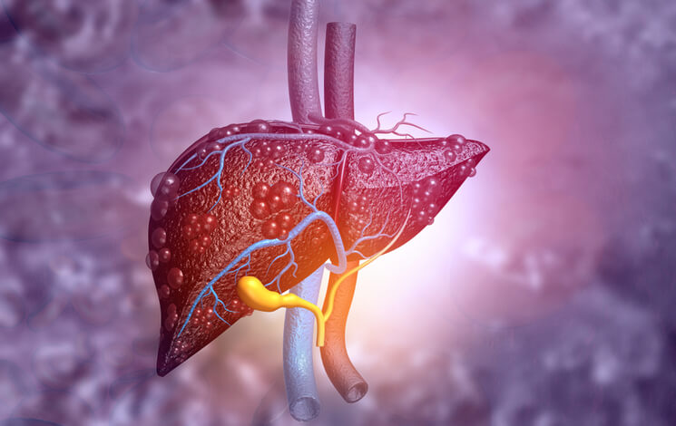 Fatty Liver: Symptoms and Causes