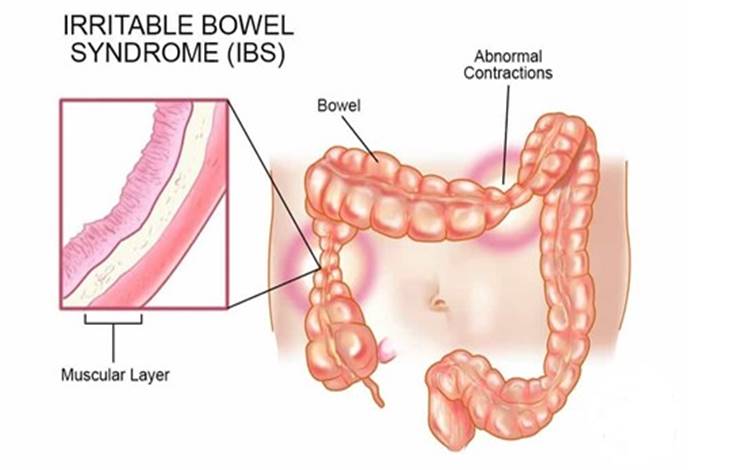 Natural Remedies for Irritable Bowel Syndrome & Ulcer