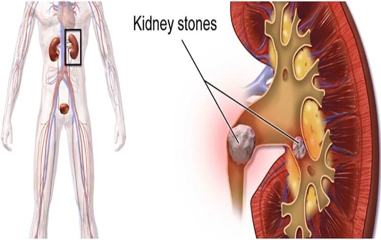 Kidney Stones and Ayurveda