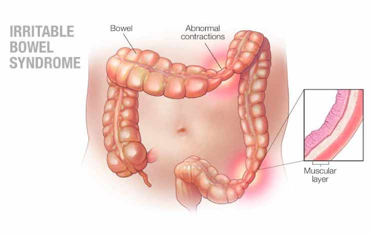 Home Remedies for IBS - The Ayurvedic Approach