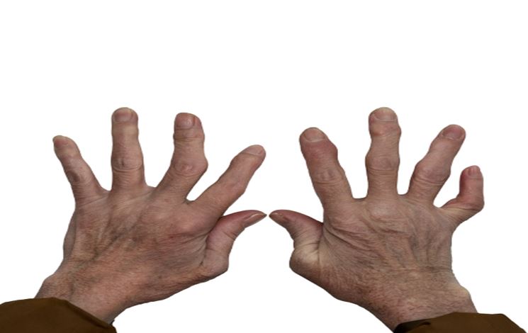 Rheumatoid Arthritis Treatment in Ayurved: Does it Really Work?