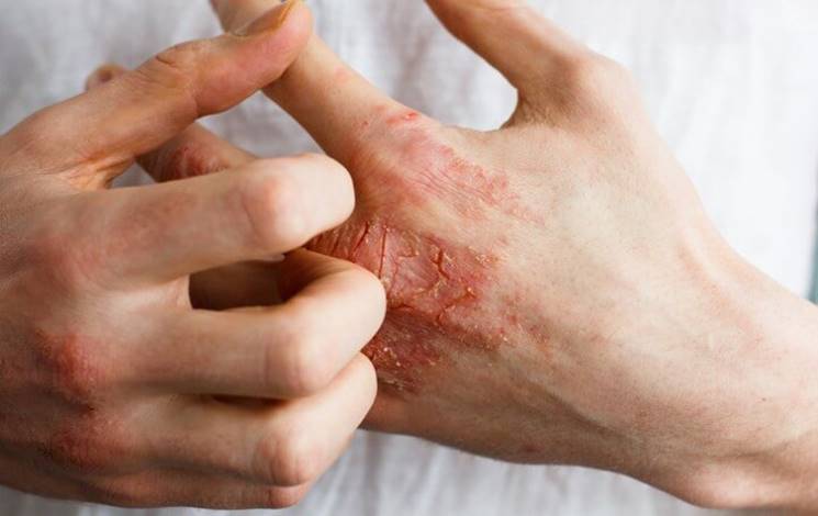 Ayurvedic treatment for eczema